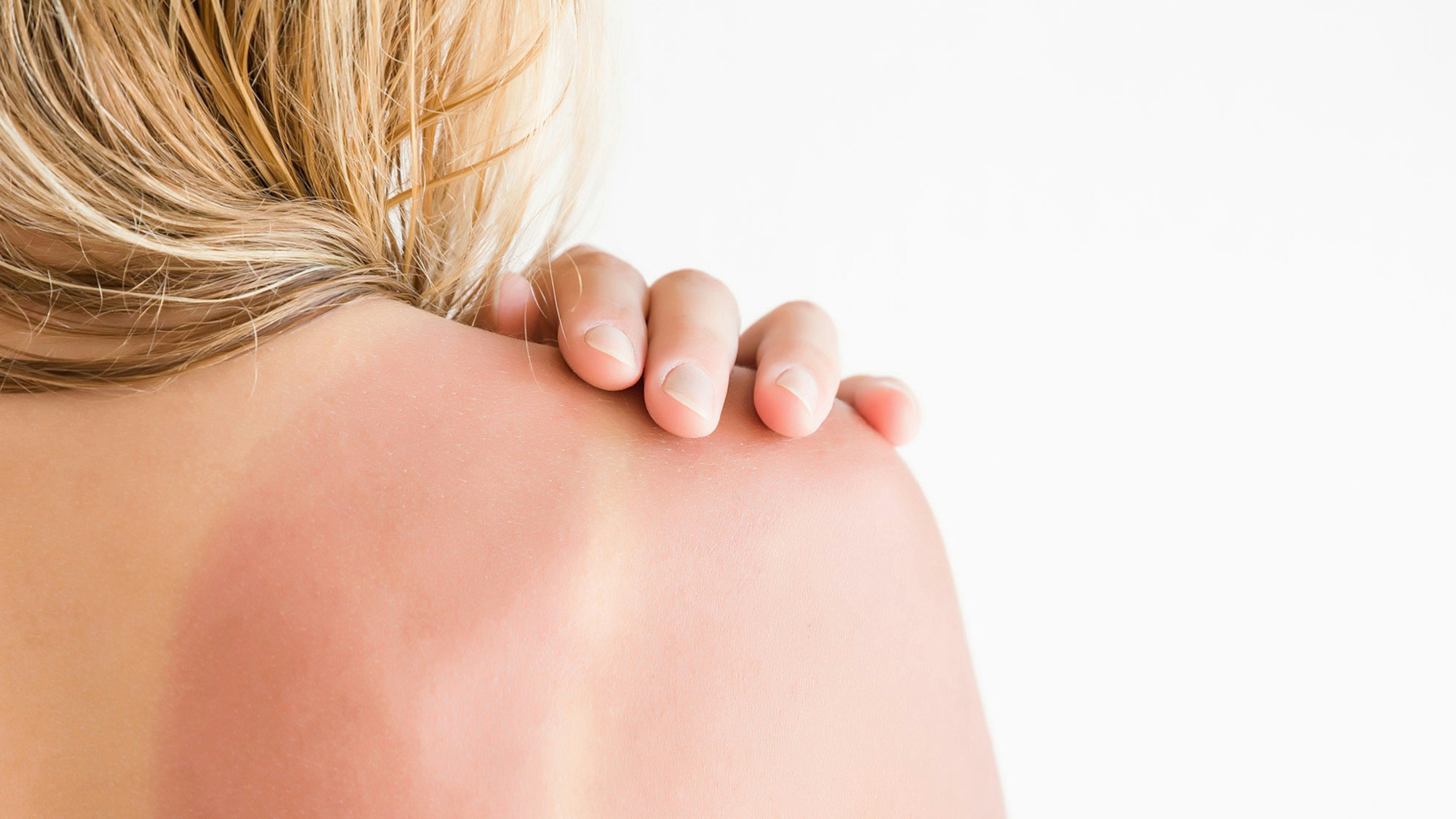 Sonnenbrand auf der Schulter einer blonden Frau